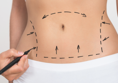 image of a stomach marked up for surgery